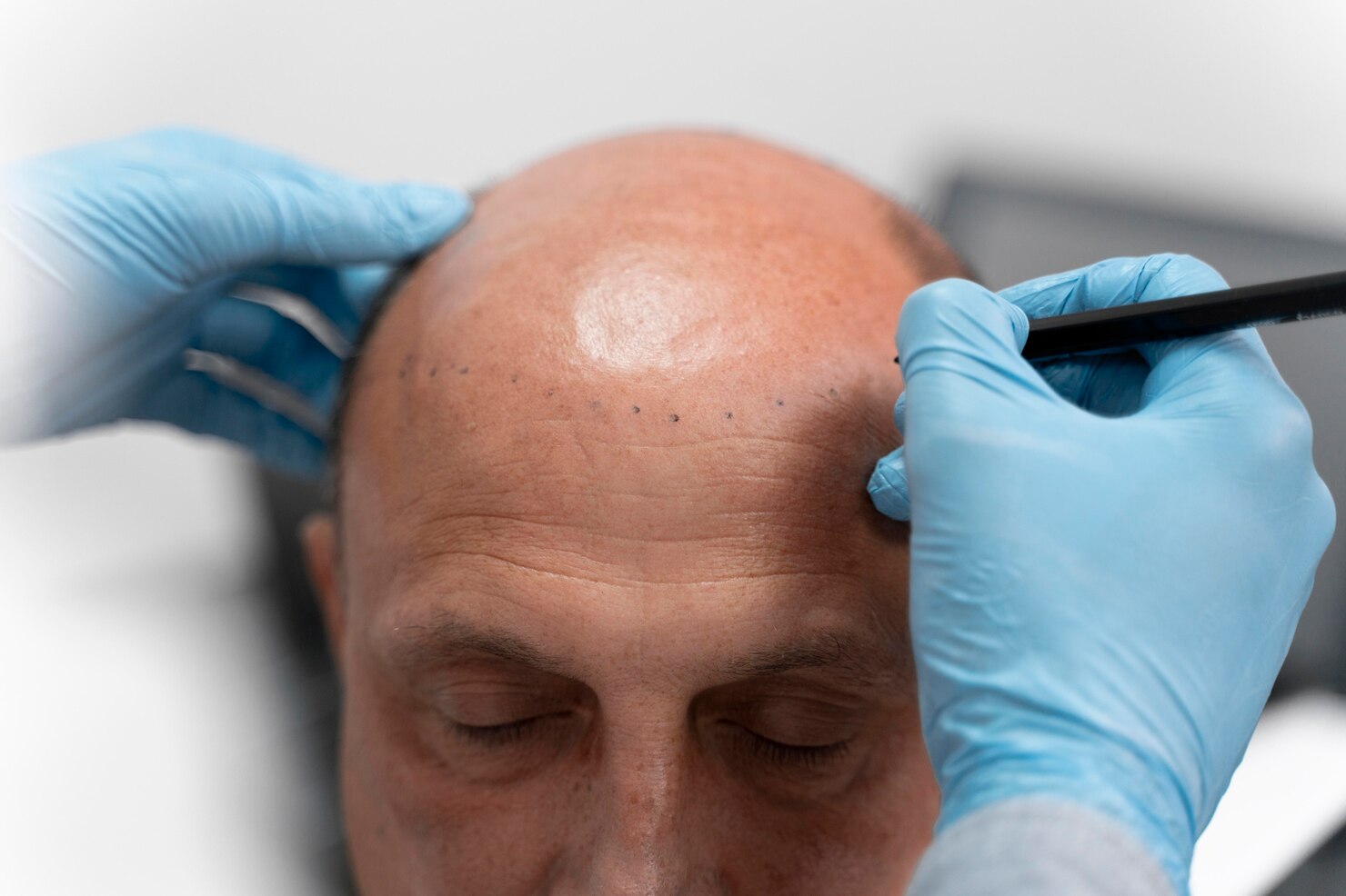 Scalp Micropigmentation for Men